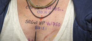 Markings like these plot where and what plastic surgeons plan to do in breast surgery. 